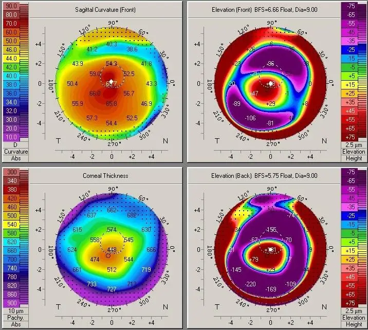 Stages of keratoconus
