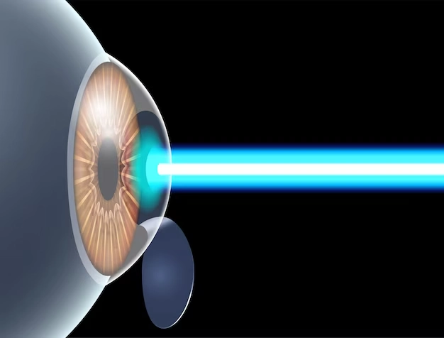 LASIK surgery price in Egypt