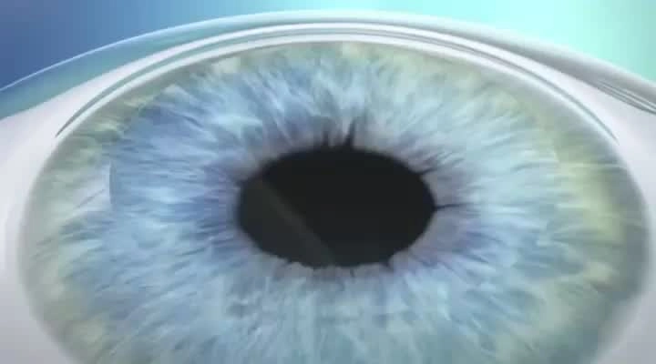 Cost of corneal transplant in Egypt