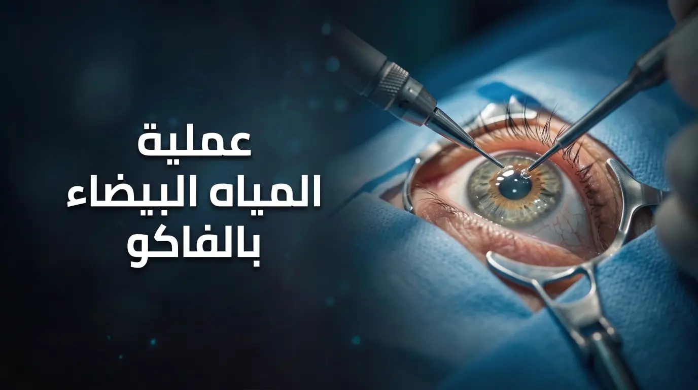عملية المياه البيضاء بالفاكو