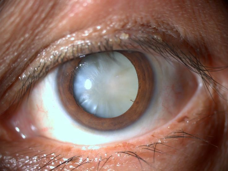 Cataracts