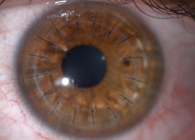 Corneal transplants