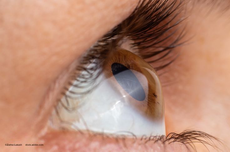 Keratoconus